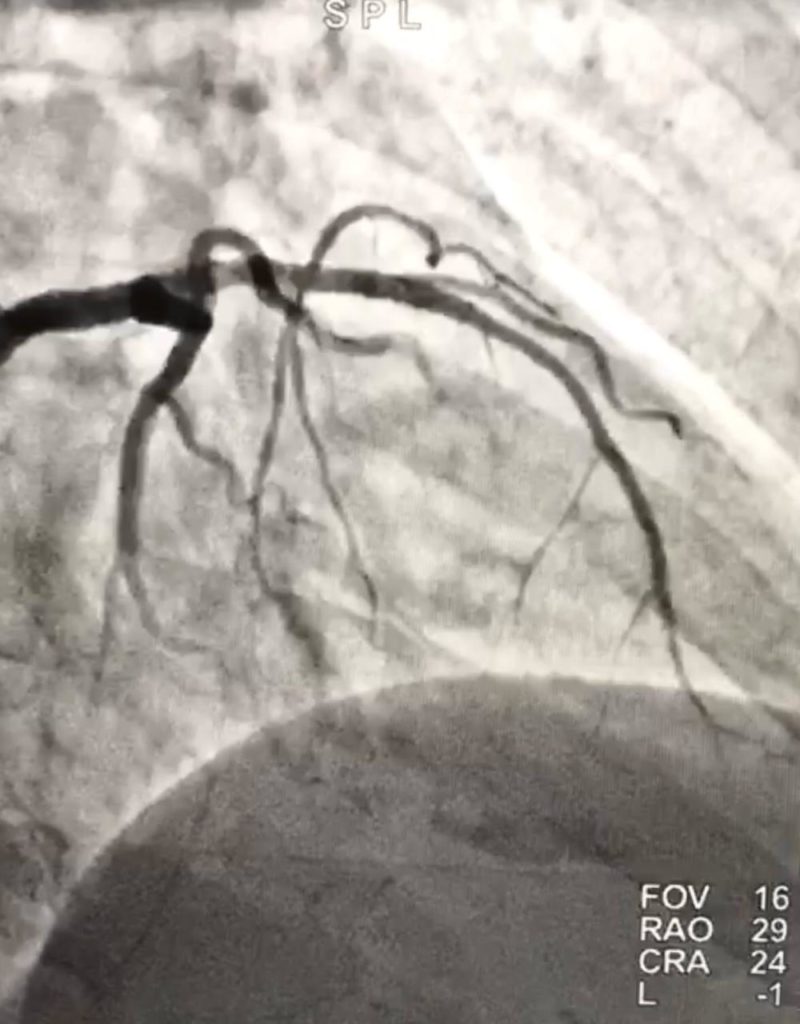 DEPOIS da Angioplastia de Oclusão Coronariana Crônica (CTO)